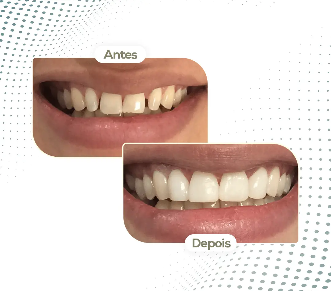 Antes e Depois